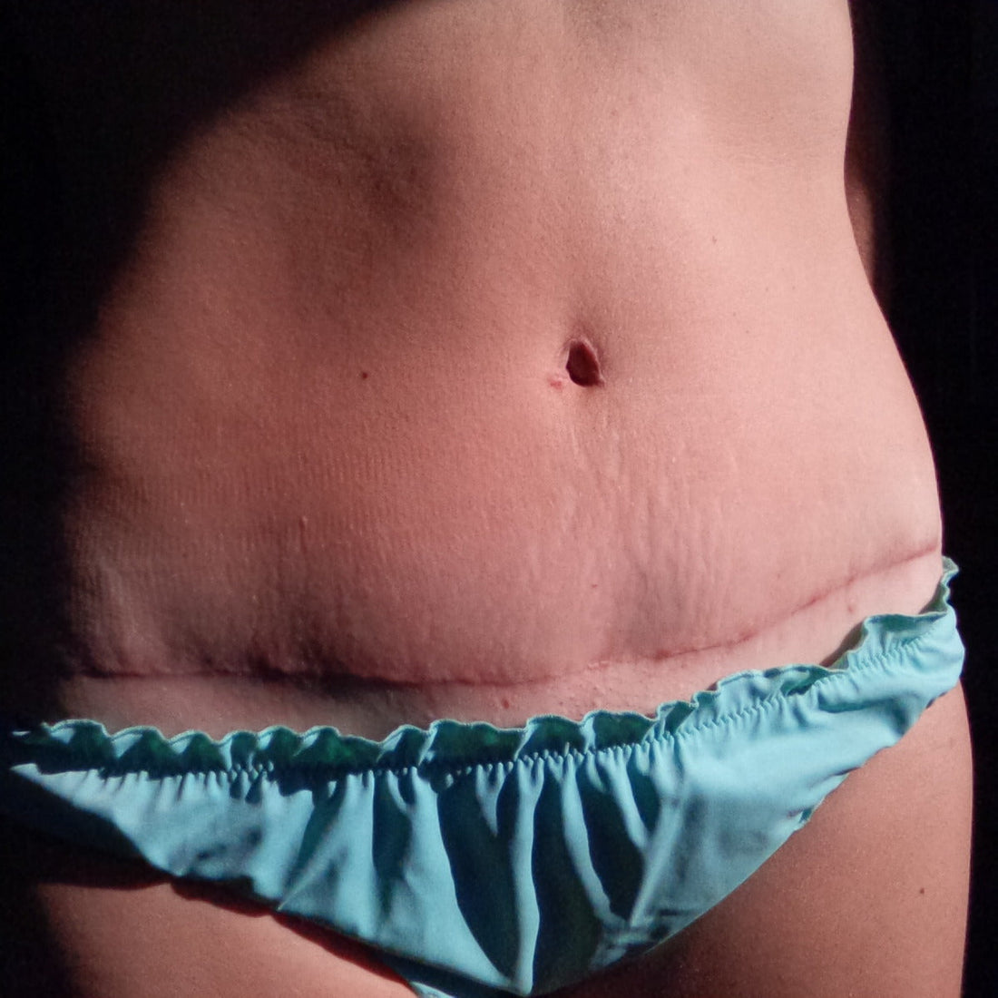 Reconnecting With Your Body After Surgery: A Gentle Guide to Feeling Like Yourself Again