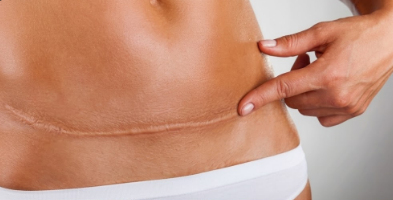 Do Cortisone Shots Work for Bad Scars?