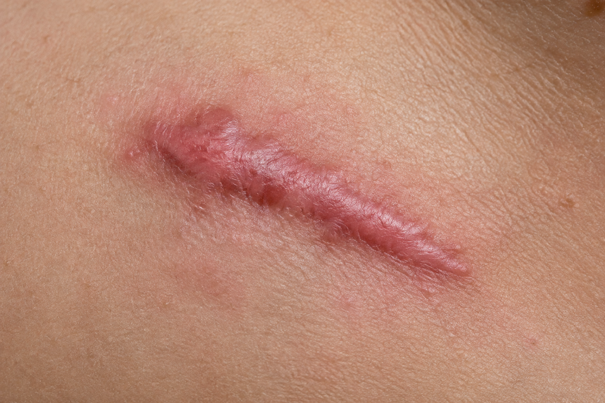 Help! My Scar is Itchy!